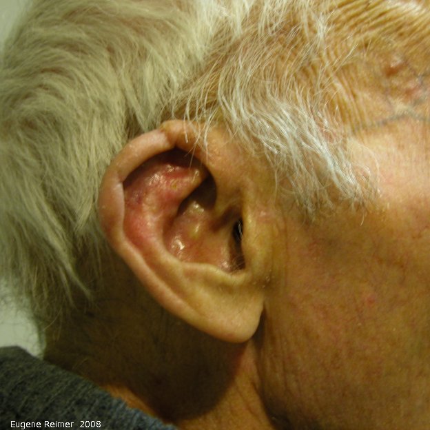 IMG 2008-Jan28 at Steinbach:  Dad injured ear